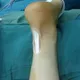 Ruptured Eardrum Hearing Loss